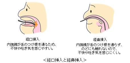 経口挿入と経鼻挿入