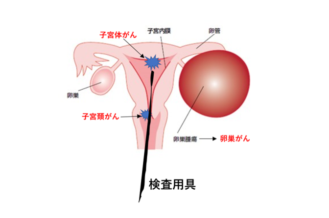 子宮体がん（子宮内膜がん）検診